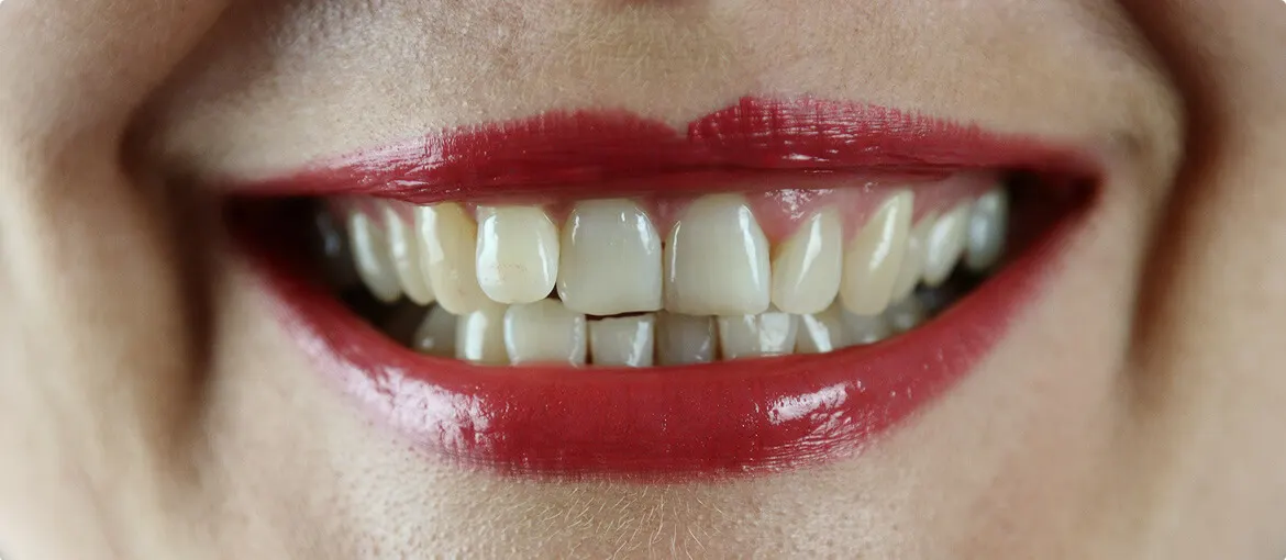 Before dental treatment at Orca Dental Clinic, Madurai